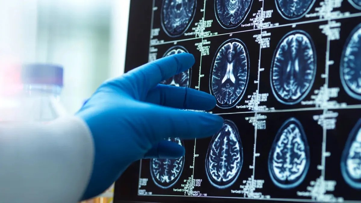 Patients participating in a clinical trial for Alzheimer's disease