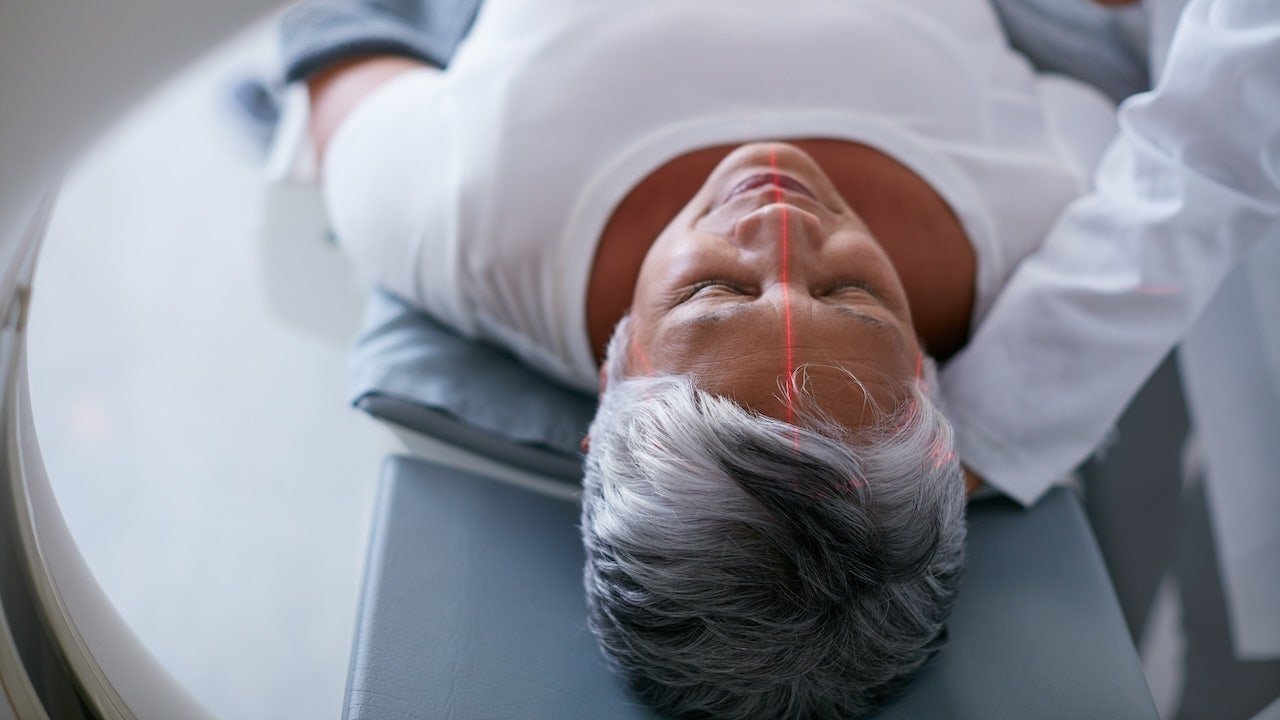 A microscopic view of brain cells showing amyloid plaques and tau tangles associated with Alzheimer's disease.